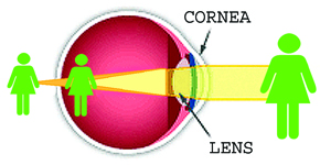 What is Astigmatism? banner