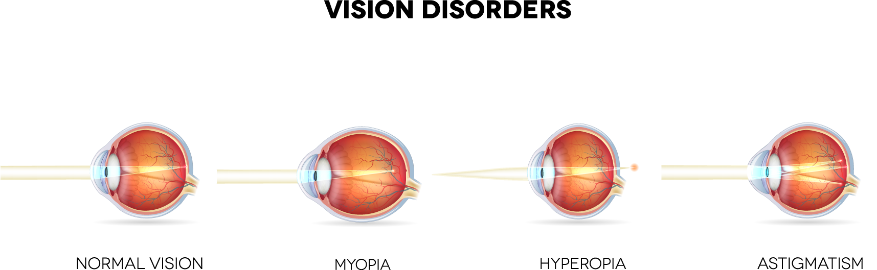 What Eye Conditions Does LASIK Treat? banner