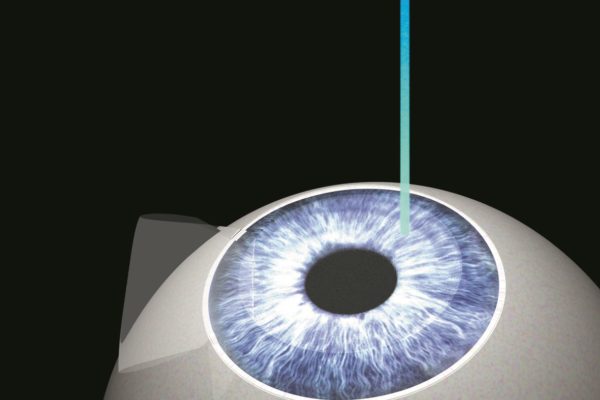 Doctors Who Perform LASIK featured image