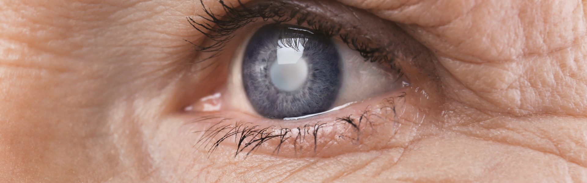Types of Cataracts banner
