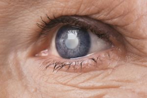 Types of Cataracts featured image